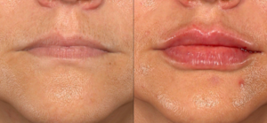 Lèvres avant et après injections?